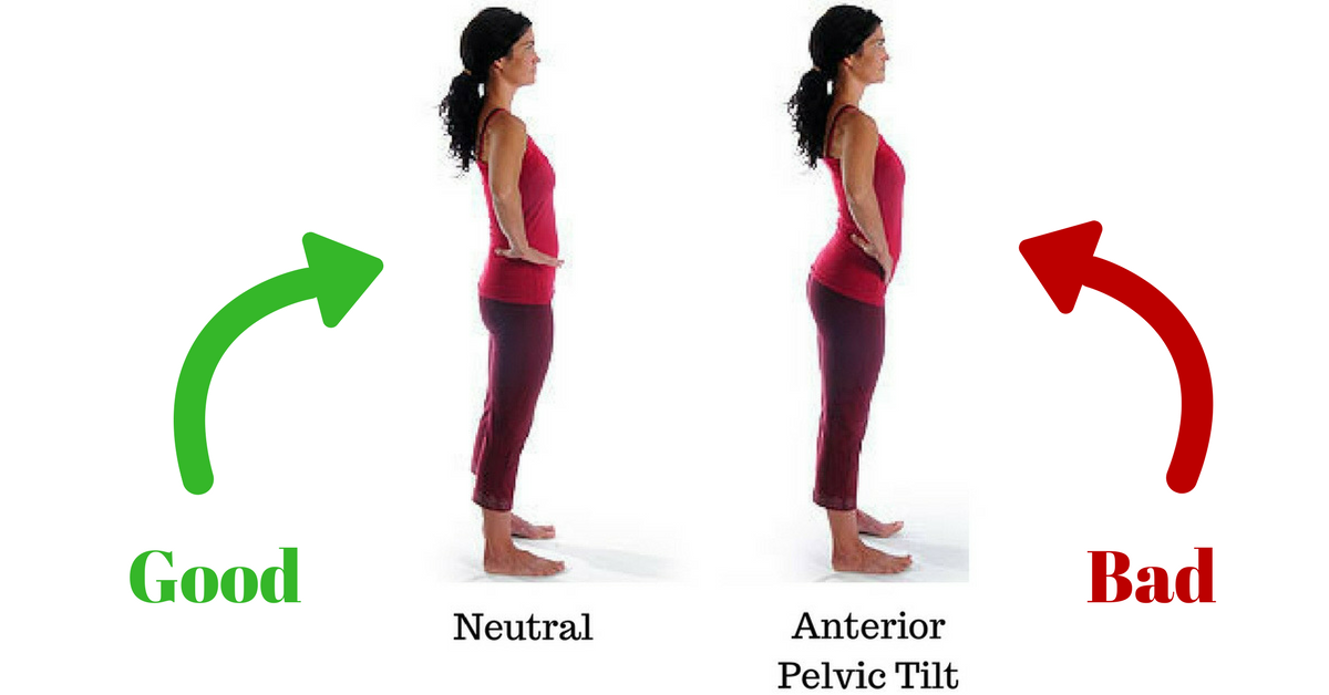 假翹臂是盤骨前傾其中一個表徵，盤骨前傾(Anterior pelvic tilt)是常見的病患情況，不分性別，年齡或職業，都有機會有患上盤骨前傾。